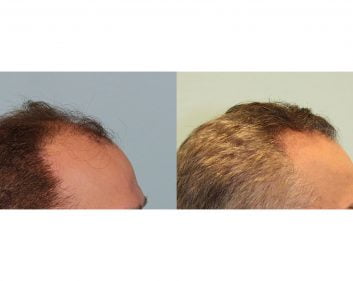 Best Hair Transplant Dallas & Colleyville – Jesse E Smith, MD, FACS