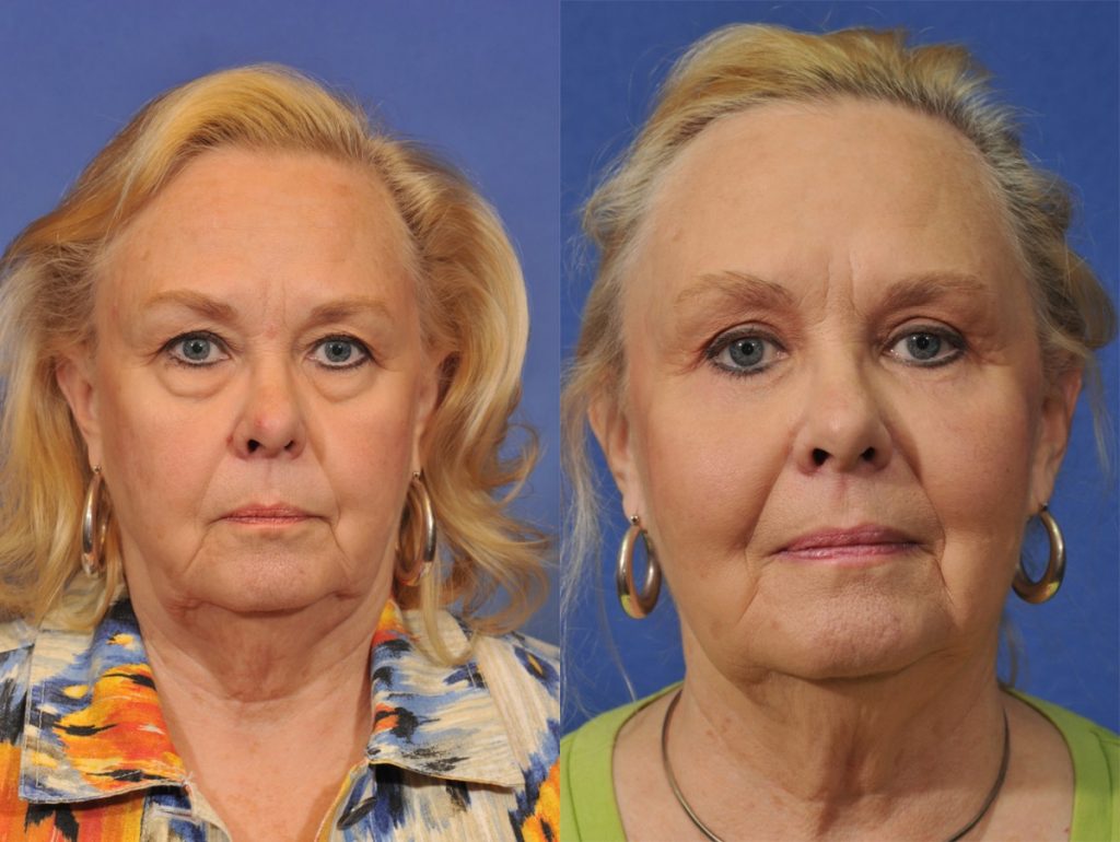 Blepharoplasty Before & After #1 before and after