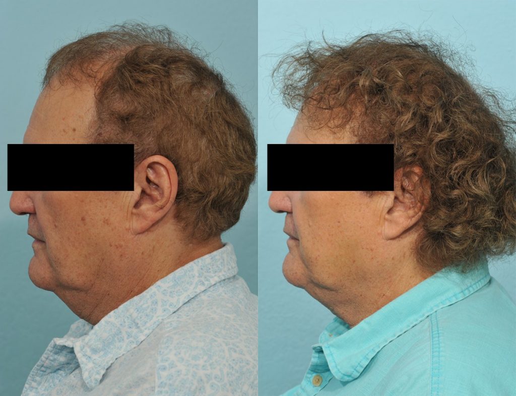 Hair Transplant Before & After #5 before and after