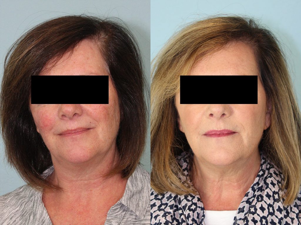 Hair Transplant Before & After #6 before and after