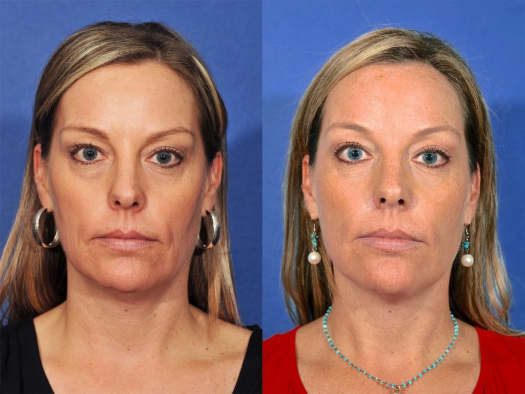 Injectables Before & After #1 before and after