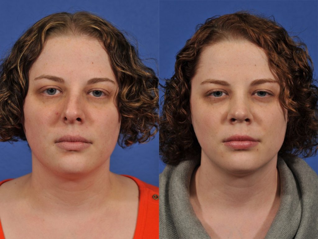 Rhinoplasty Before & After #2 before and after