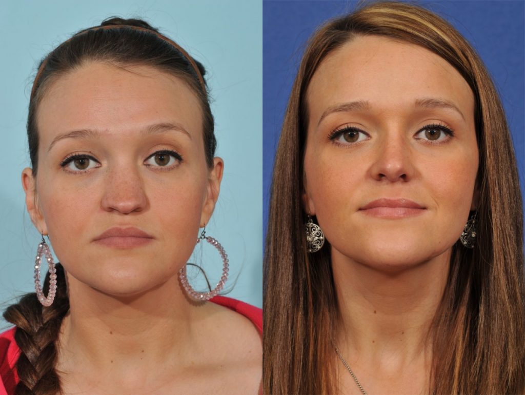Rhinoplasty Before & After #3 before and after