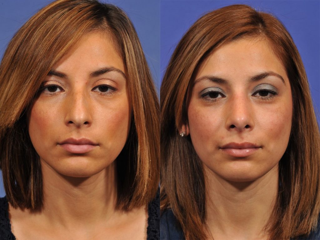 Rhinoplasty Before & After #6 before and after