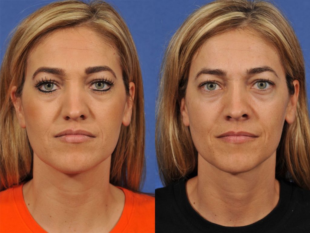 Rhinoplasty Before & After #7 before and after