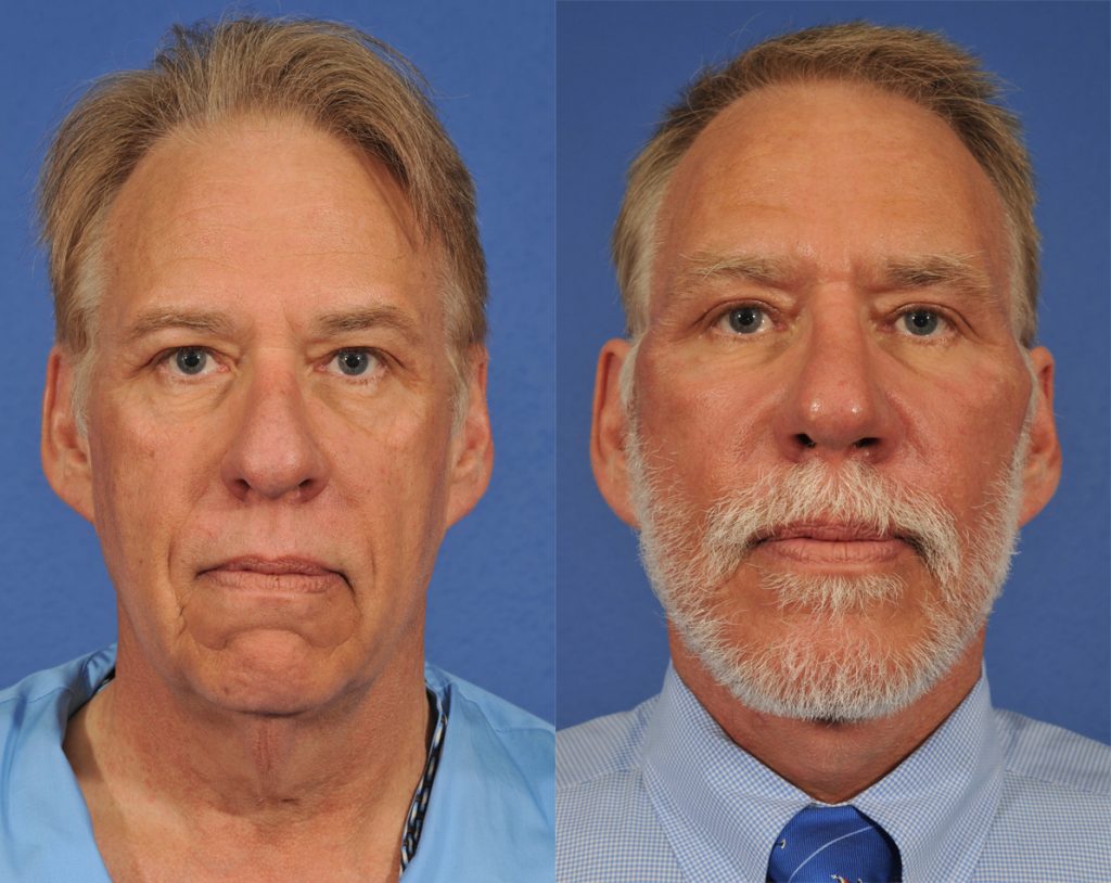 Rhinoplasty and Facelift Before & After #1 before and after