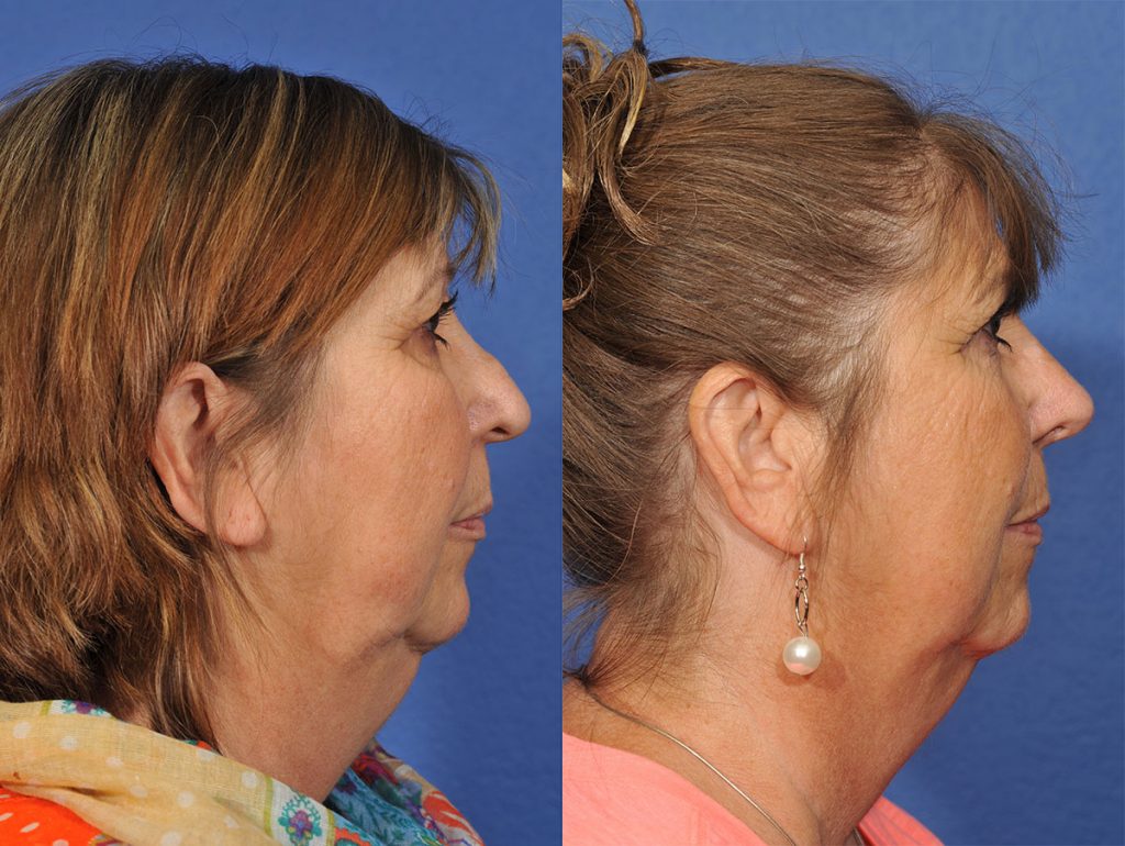 Revision Rhinoplasty Before & After #1 before and after