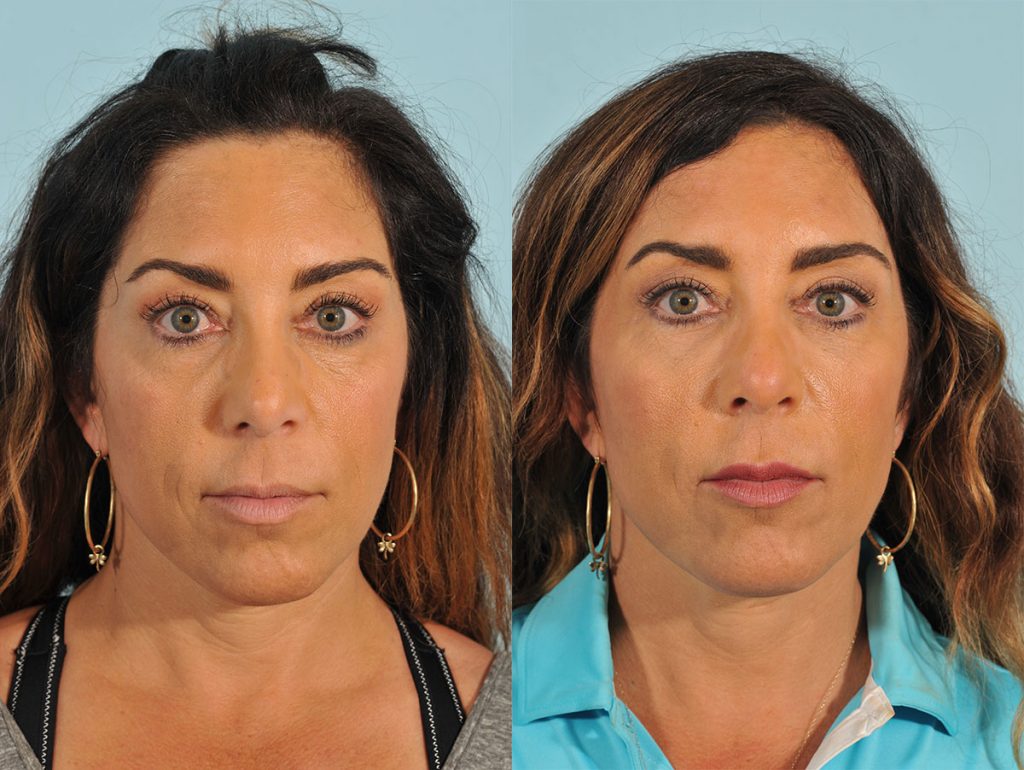 Injectables Before & After #4 before and after