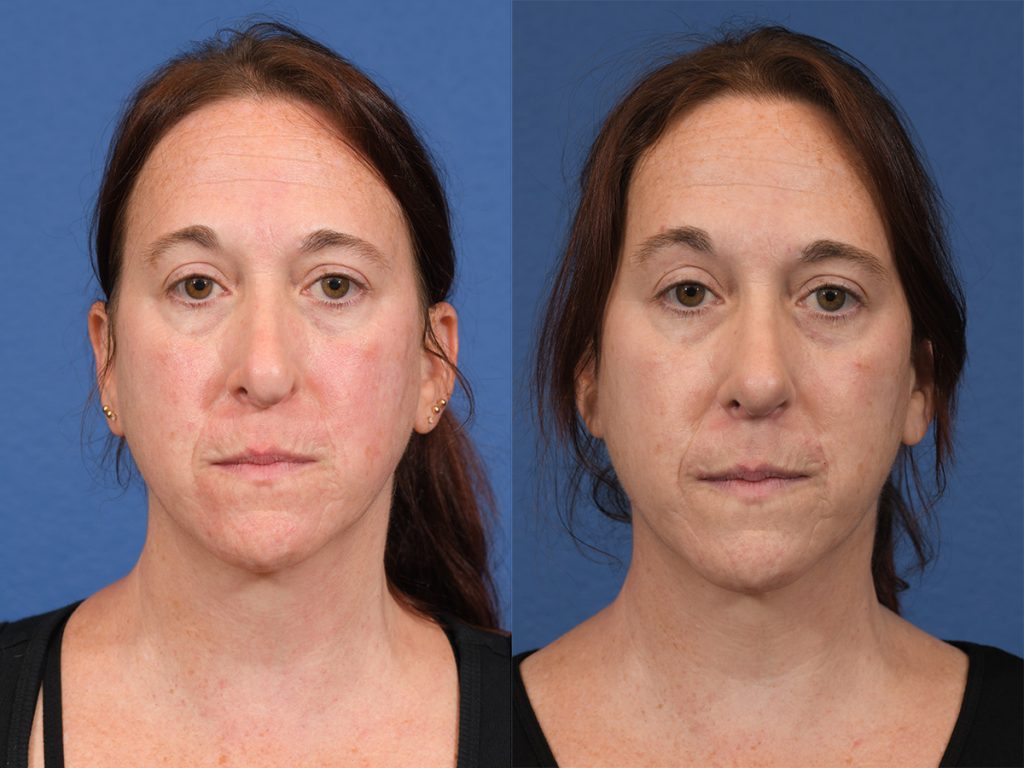 Rhinoplasty Before & After #11 before and after