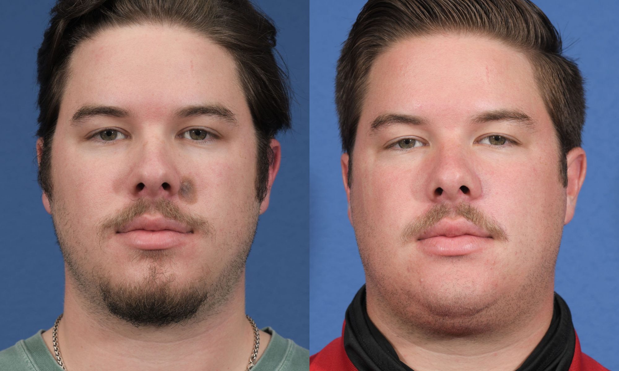 Reconstruction Before & After 1