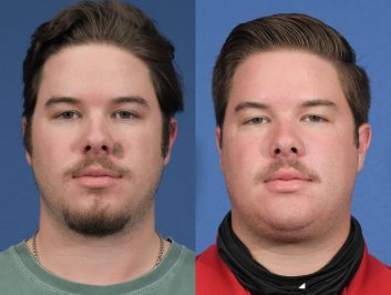 Reconstruction Before & After 1