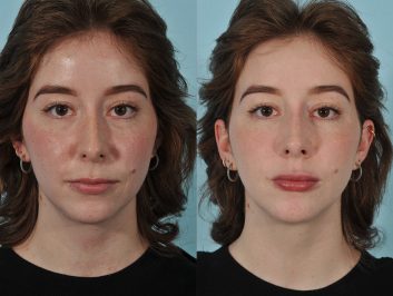injectables-before-after-5ab