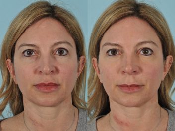 Injectables Before & After 6ab