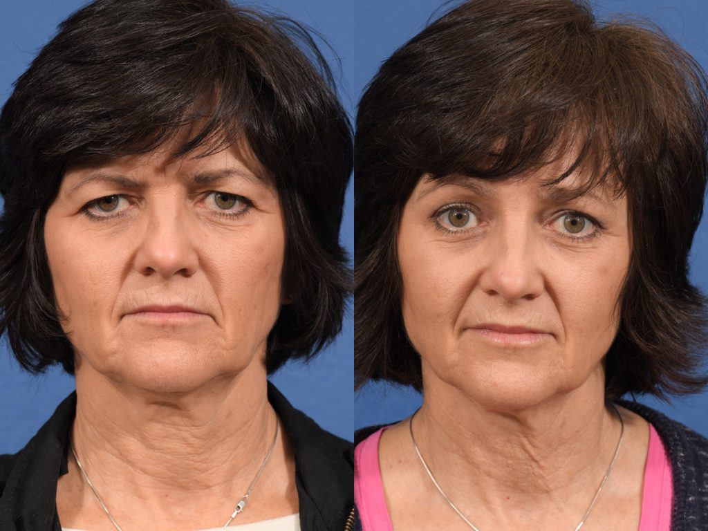 Blepharoplasty Before & After #2 before and after