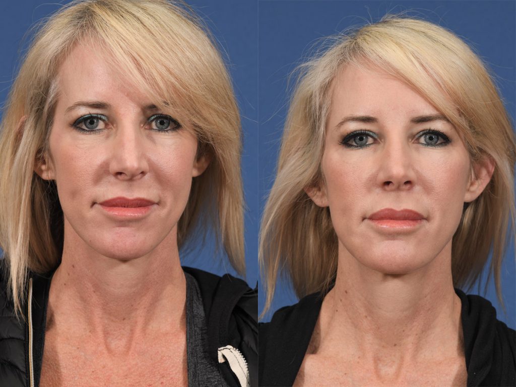 Injectables Before & After #7 before and after