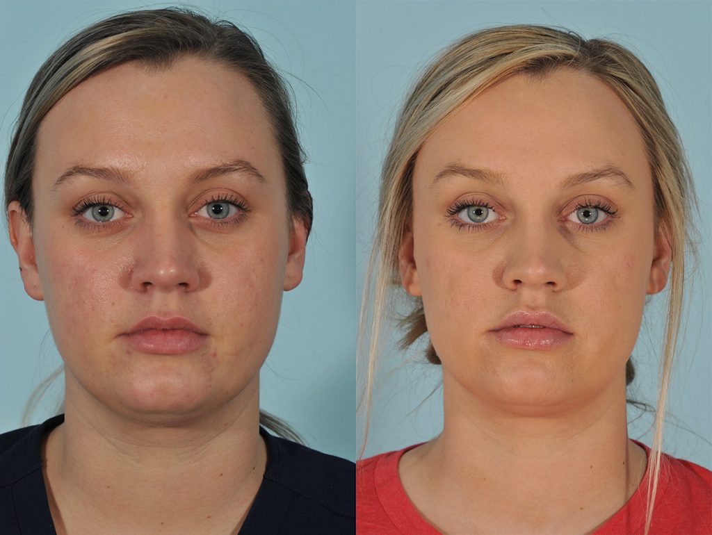 Injectables Before & After #8 before and after