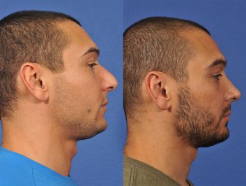 rhinoplasty-before-after-12cd