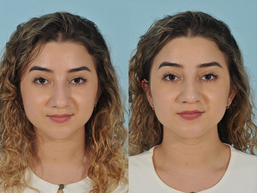Injectables Before & After #9 before and after