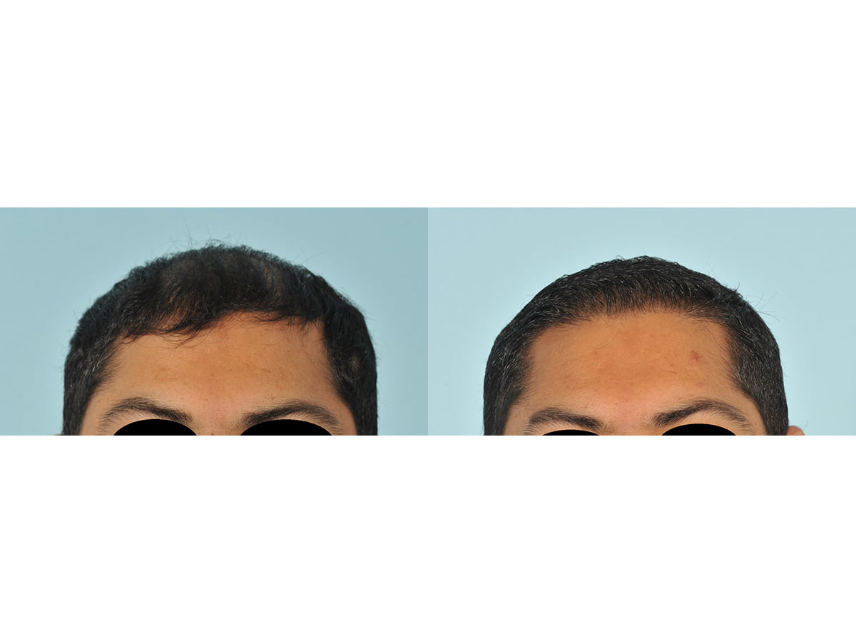 Hair Transplant Before & After #7