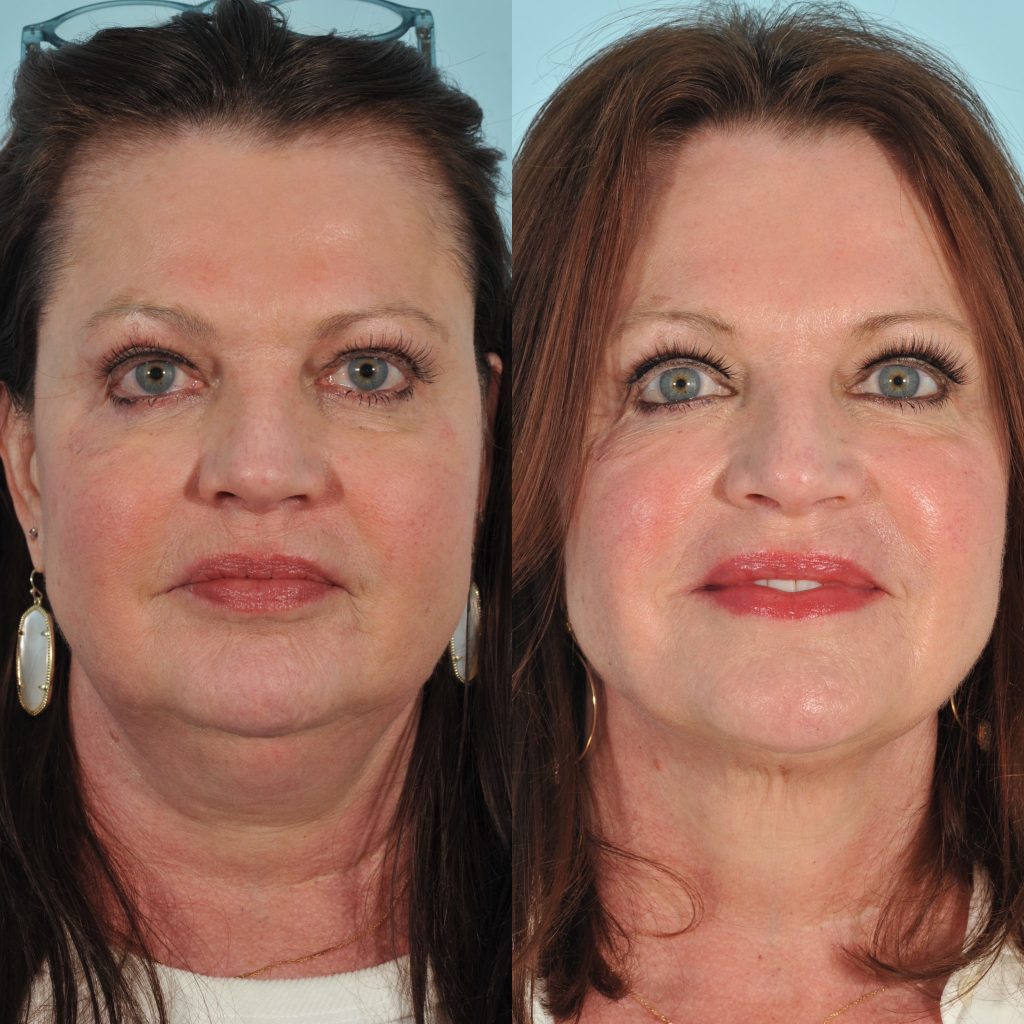Kybella Before & After #3 before and after