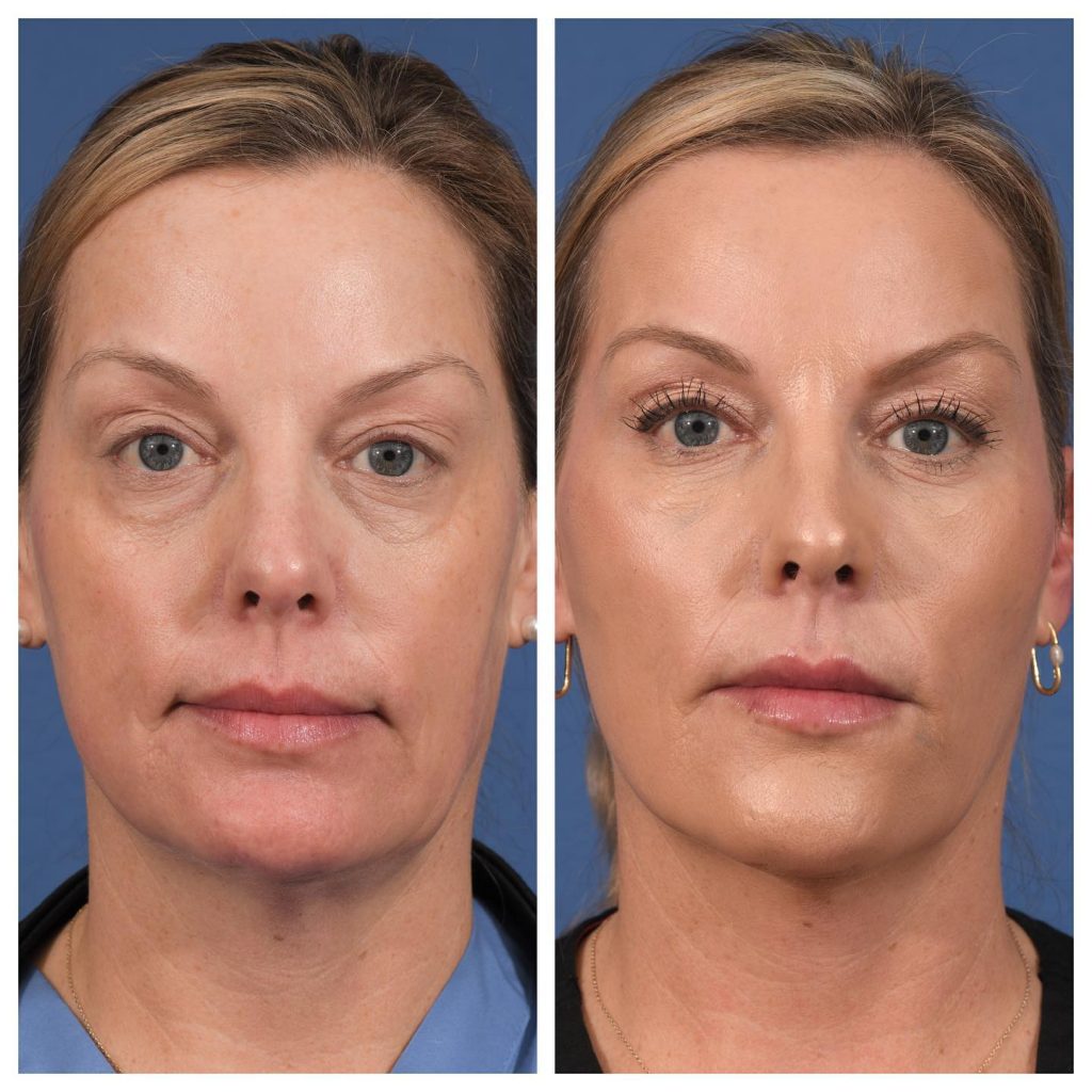 Injectables Before & After #11 before and after