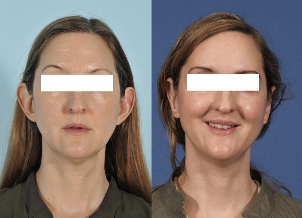 Otoplasty Before & After #1 before and after