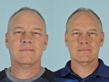 Upper Blepharoplasty 3