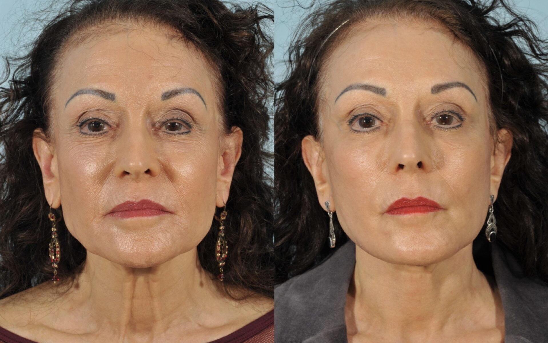 Facelift Before & After 2