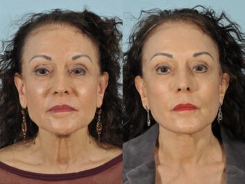 Facelift Before & After 2