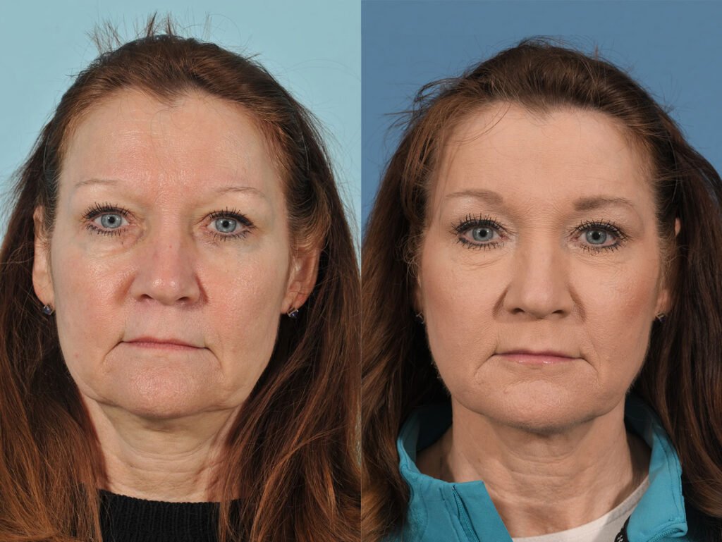 Injectables Before & After #13 before and after