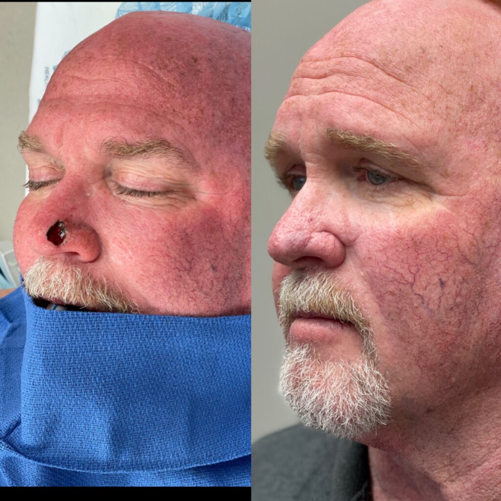 MOHS Reconstruction Before & After 2 before and after