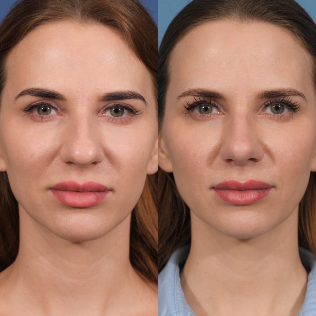 Preservation Rhinoplasty Before & After #18 before and after