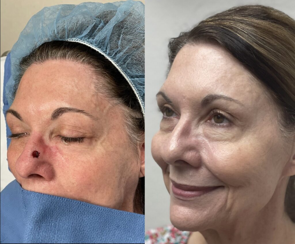 MOHS Reconstruction Before & After 8 before and after