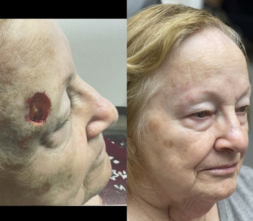MOHS Reconstruction Before & After 3 before and after