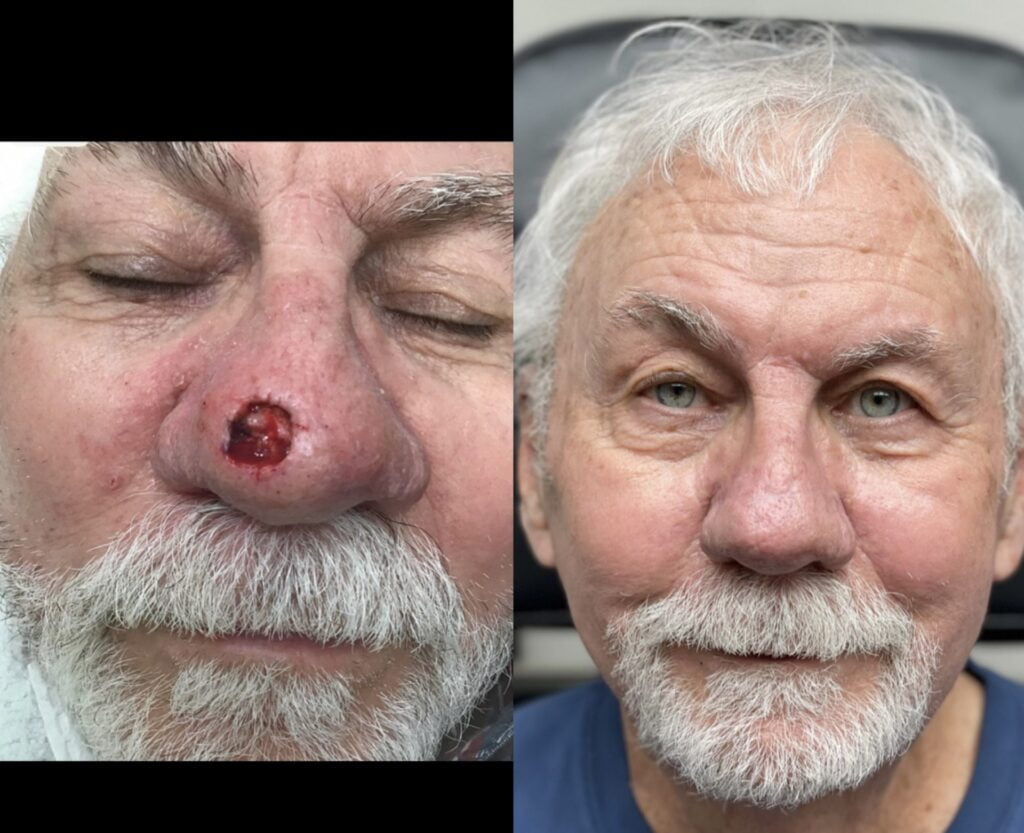 MOHS Reconstruction Before & After 5 before and after