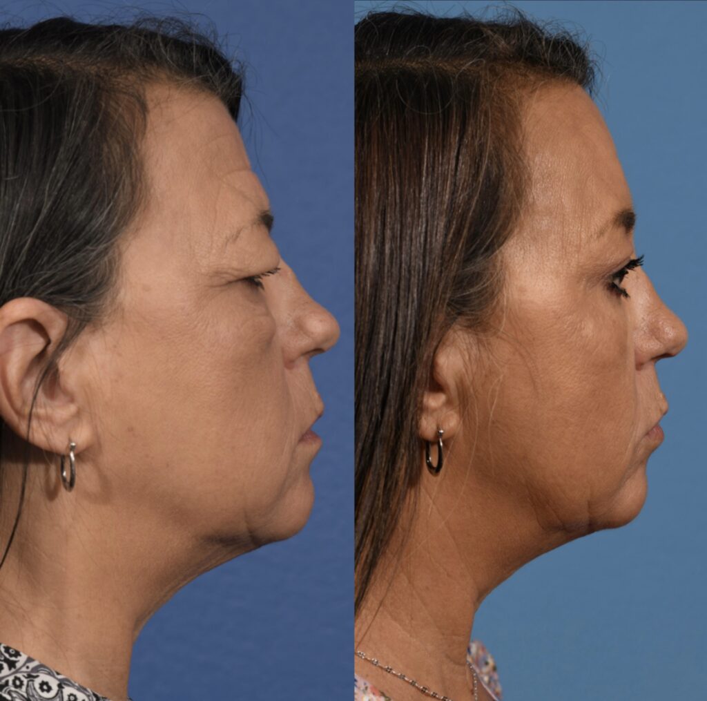 Blepharoplasty Before & After #4 before and after
