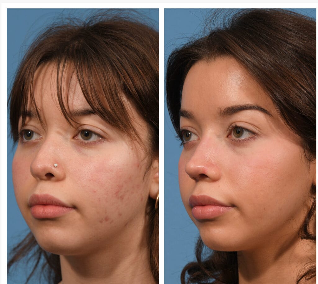 Rhinoplasty Before & After #23 before and after