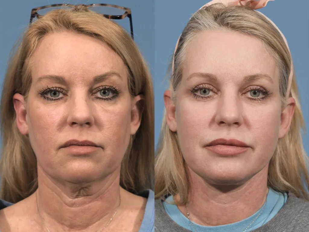 Neck Lift Before & After #2 before and after