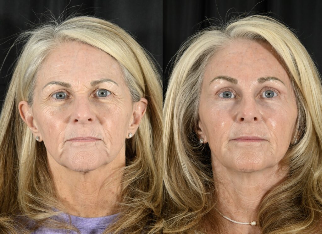 Blepharoplasty Before & After #5 before and after