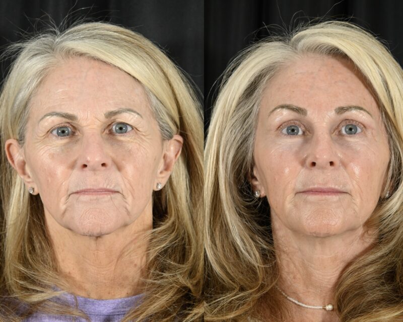 Blepharoplasty Before & After #5
