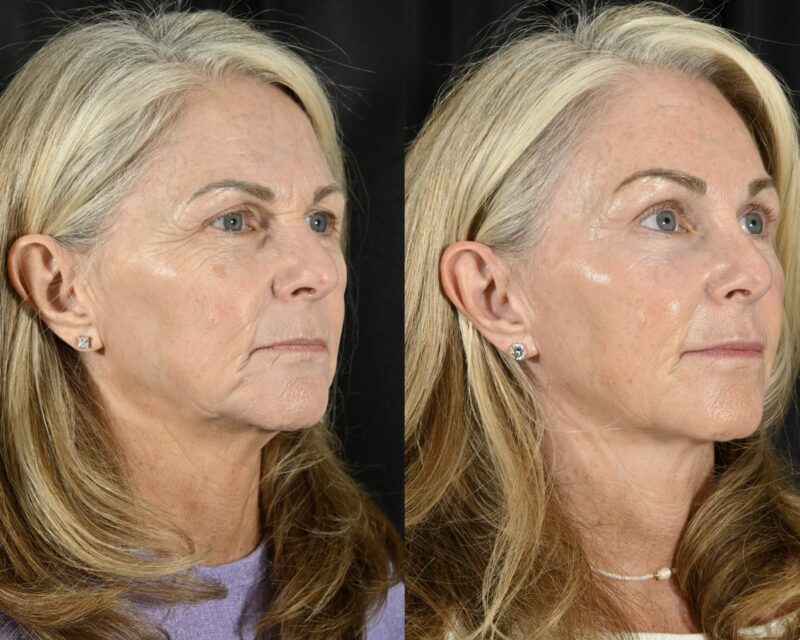 Blepharoplasty Before & After #5 image 2
