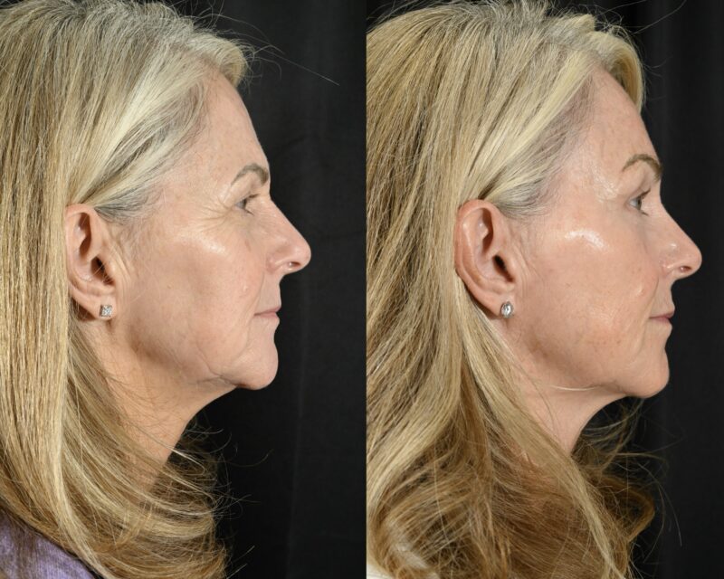 Blepharoplasty Before & After #5 image 3