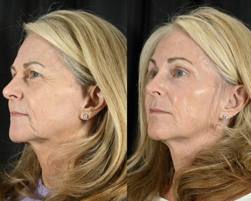 Blepharoplasty Before & After #5 image 4