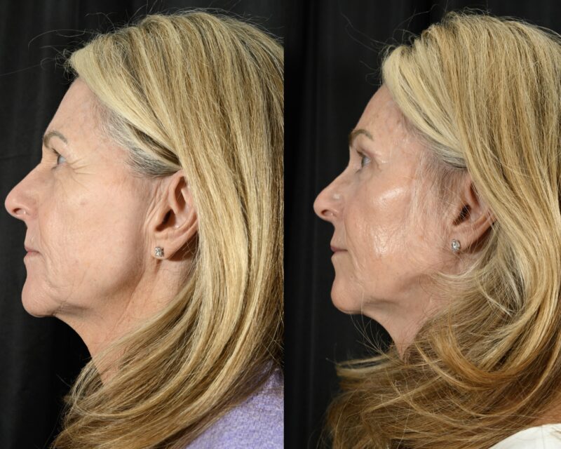 Blepharoplasty Before & After #5 image 5
