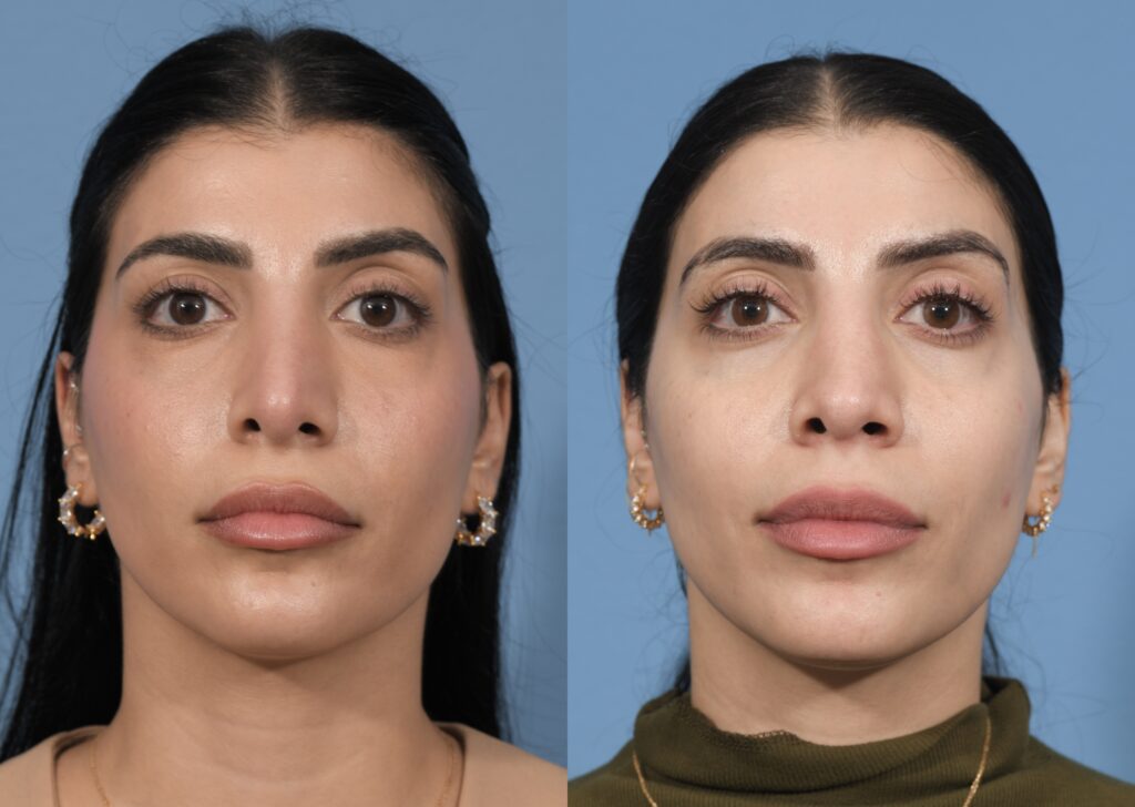 Revision Rhinoplasty Before & After #3 before and after
