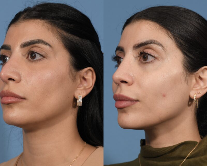 Revision Rhinoplasty Before & After #3 image 2