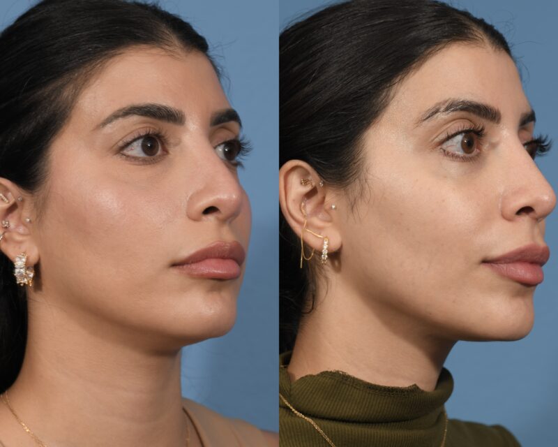 Revision Rhinoplasty Before & After #3 image 3