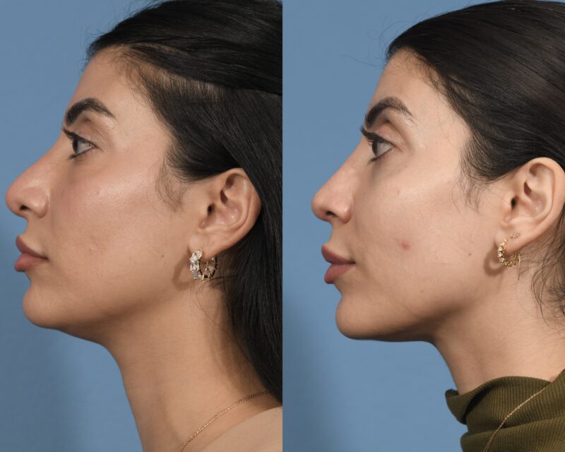 Revision Rhinoplasty Before & After #3 image 4