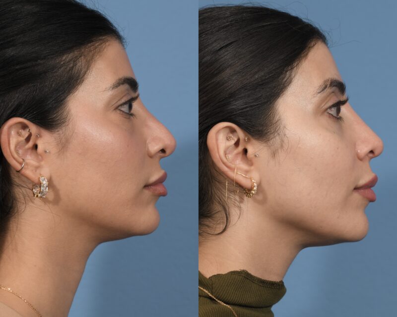 Revision Rhinoplasty Before & After #3 image 5
