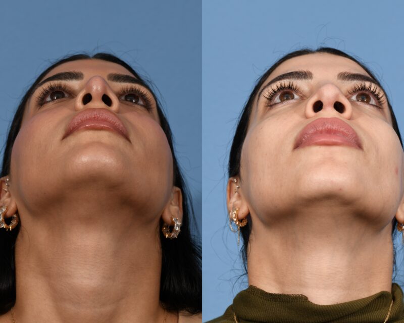 Revision Rhinoplasty Before & After #3 image 6